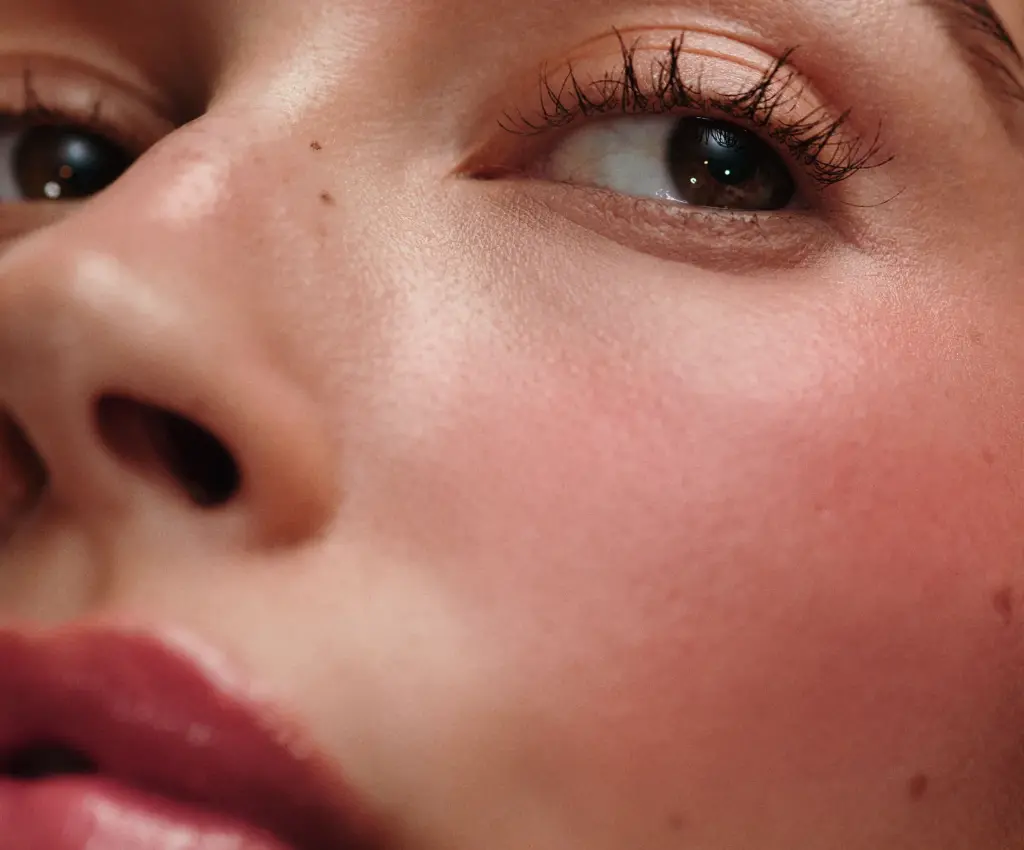 freckle3.webp